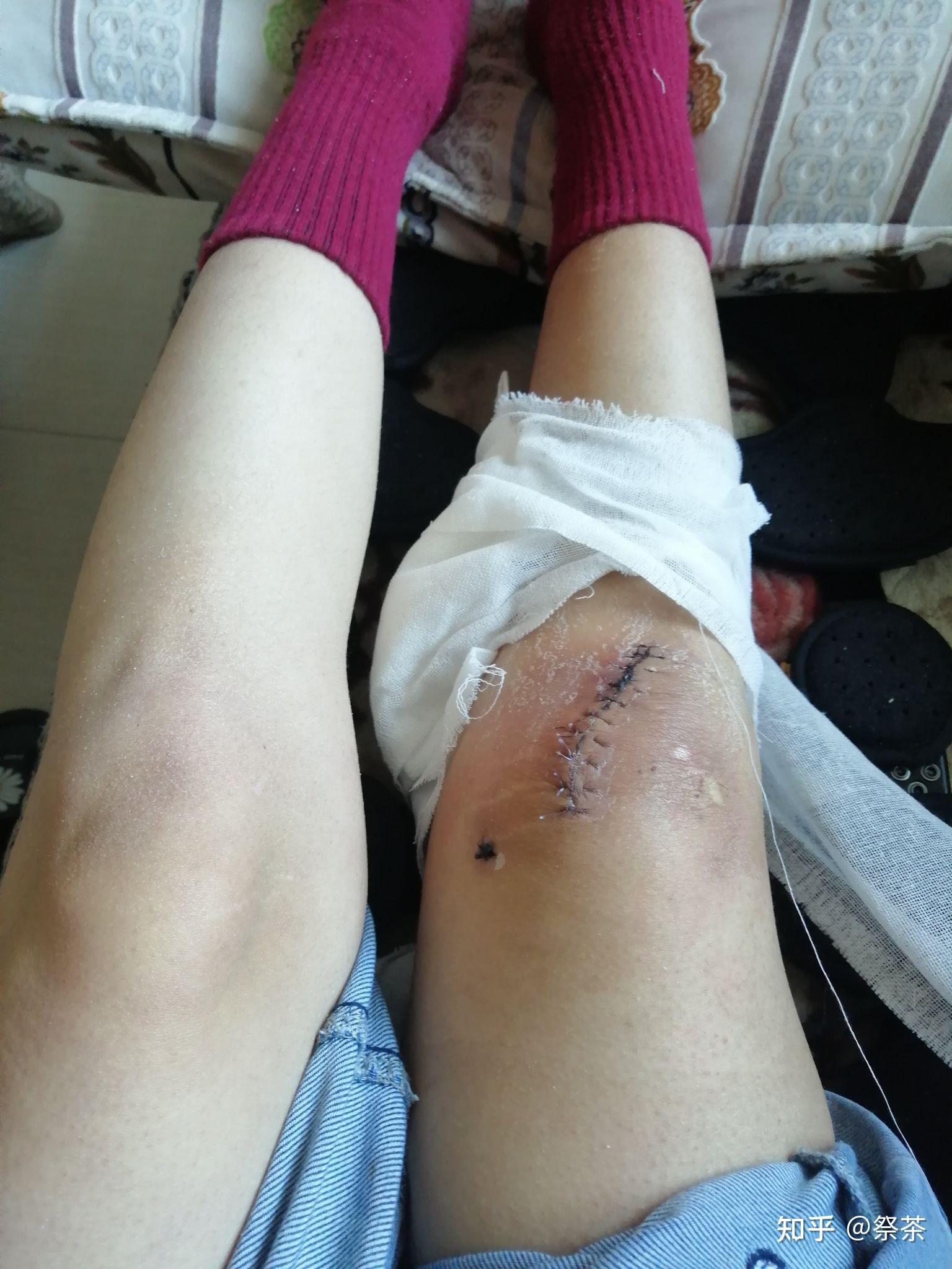 那些经历过髌骨骨折手术的人5年10年20年后现在都怎么样了是否一切