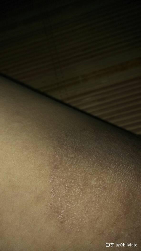 男士大腿内侧发黑该怎么解决?