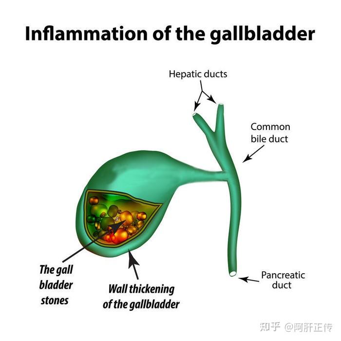 急性胆囊炎的症状、病因、保守治疗与微创手术 - 知乎