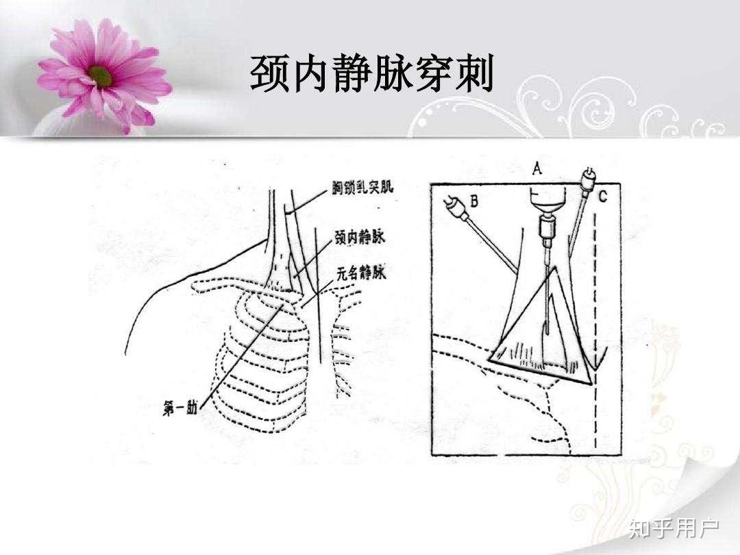 颈静脉穿刺技巧? - 知乎