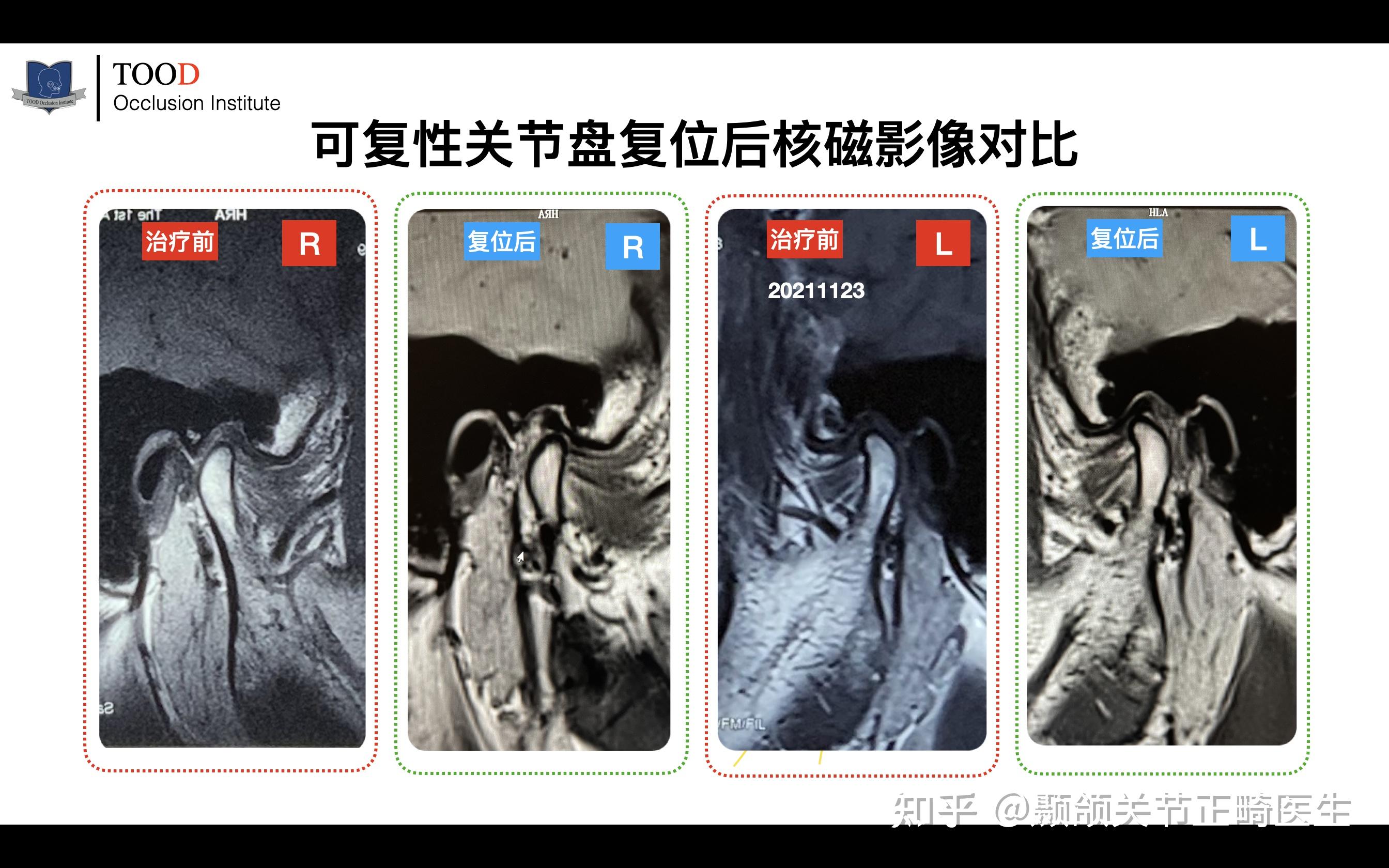 颞下颌关节 可复性 移位 张嘴弹响能治愈吗?