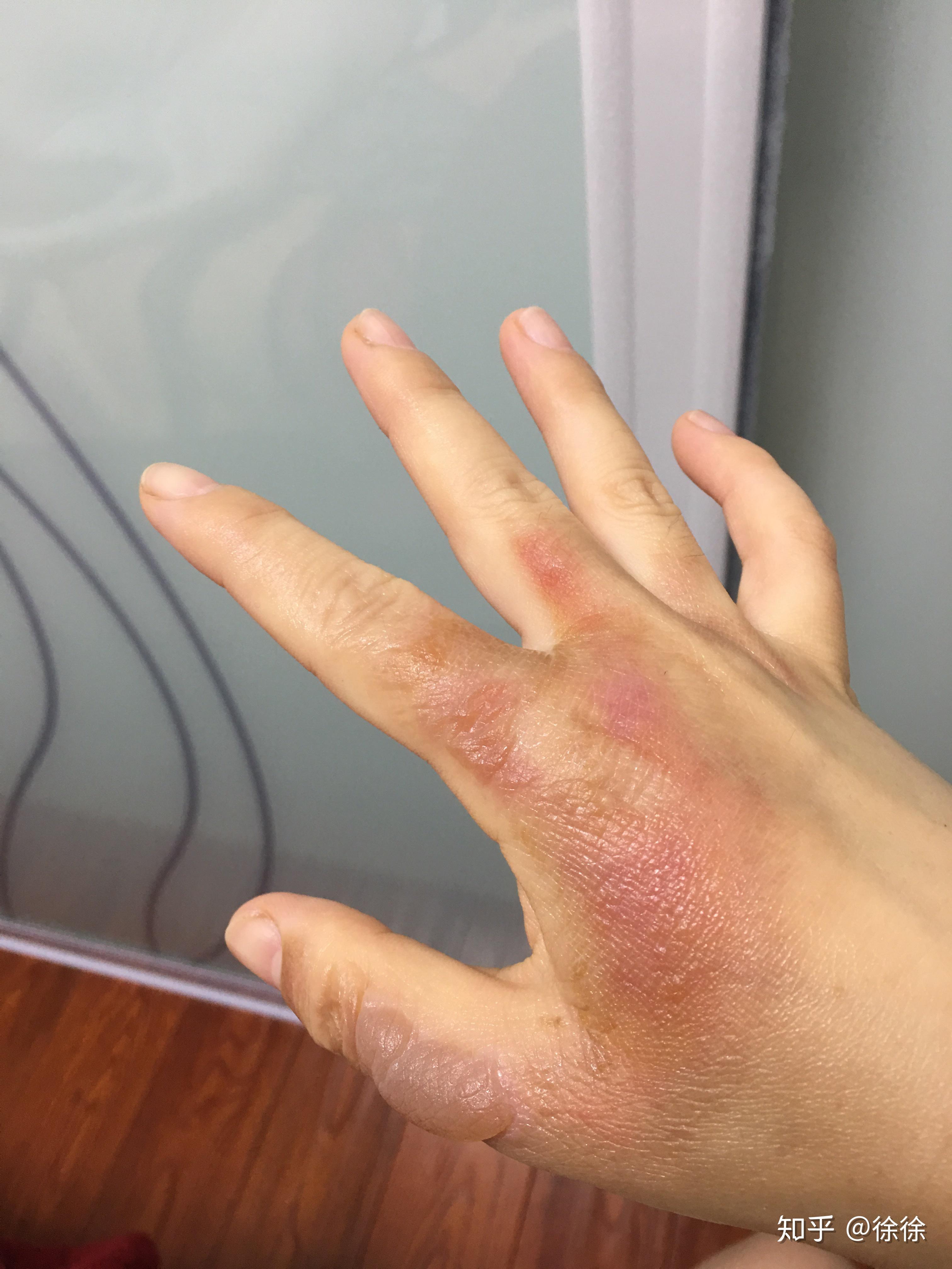 烫伤起的水泡可以戳破吗?