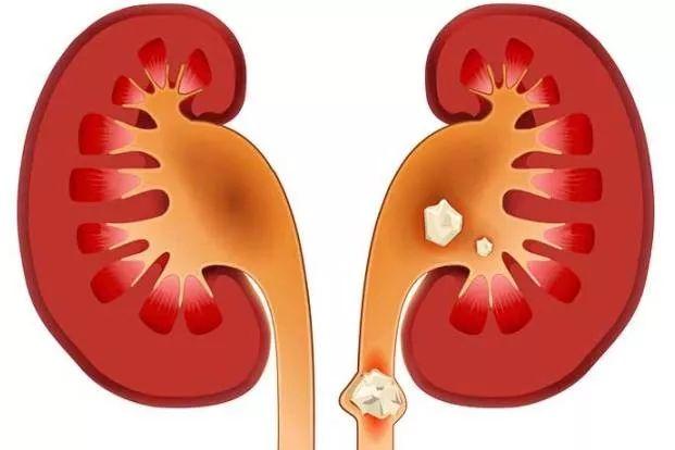 腎結石排石有幾個階段這幾步你一定不瞭解