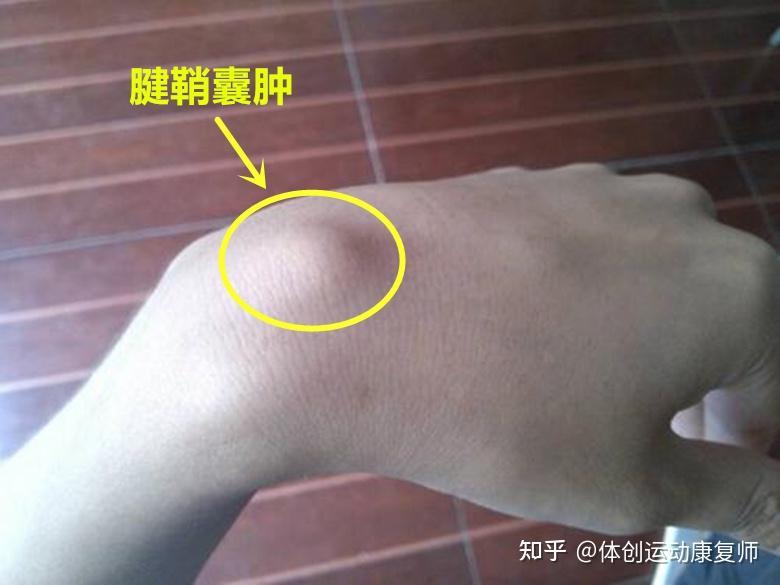 怎样非手术治疗手腕腱鞘囊肿