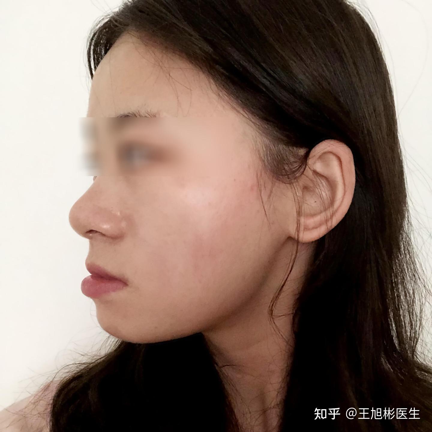 鼻基底凹陷怎么改善侧脸像一块板或者有什么医美仪器提拉一下有效果吗