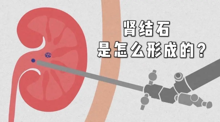 肾结石是怎么样逐渐形成的呢? - 知乎