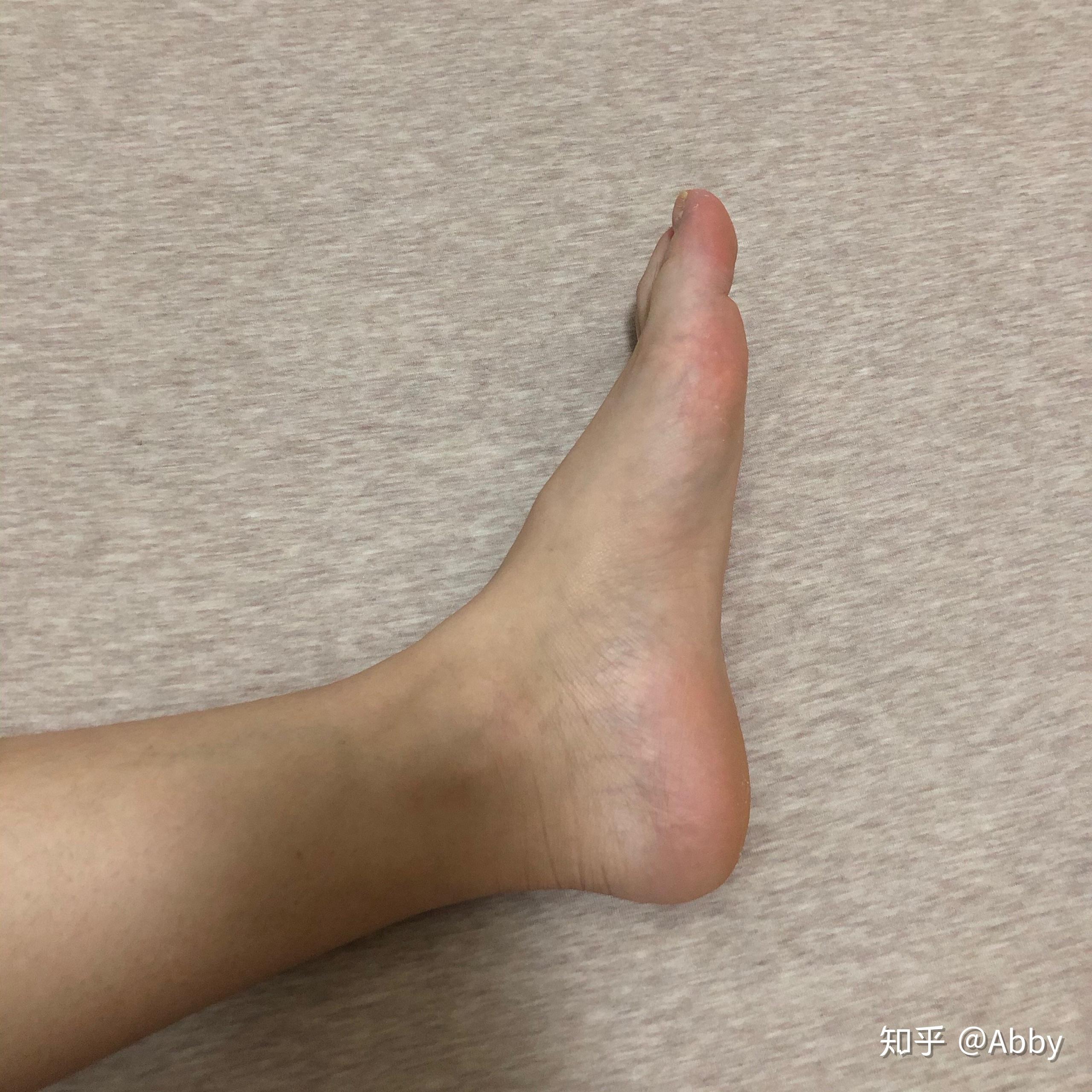 本人是低足弓想学舞蹈25岁了脚背特别高几乎是铲子如图请问我这样的脚