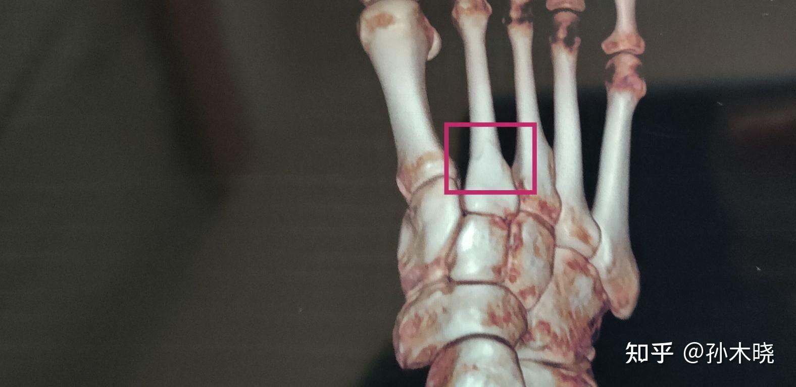 左腳第二蹠骨骨折需要多久才能正常走路