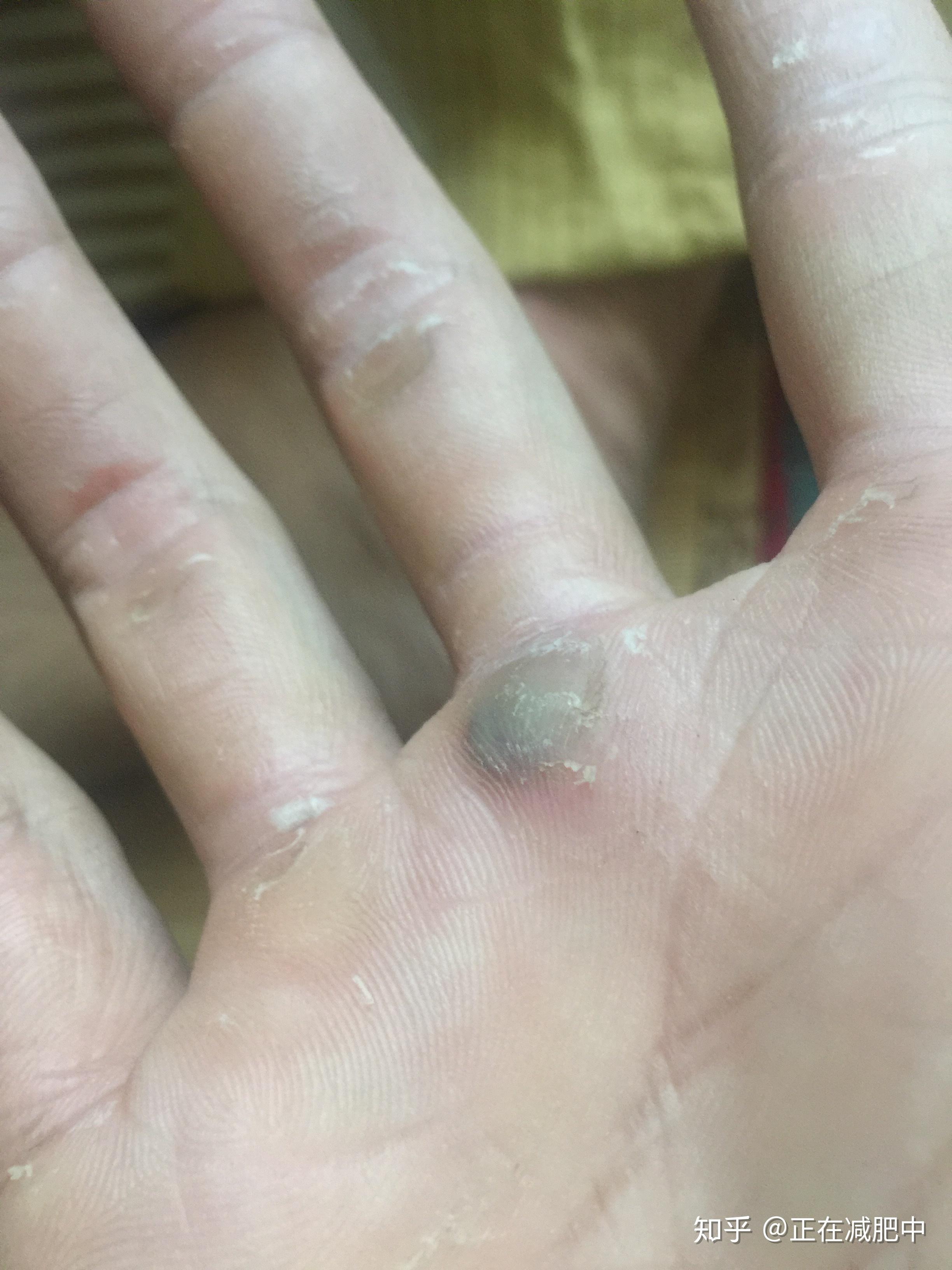 健身手破皮一般怎么处理? - 知乎