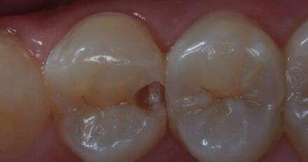 牙齿侧面蛀了个洞能不能补