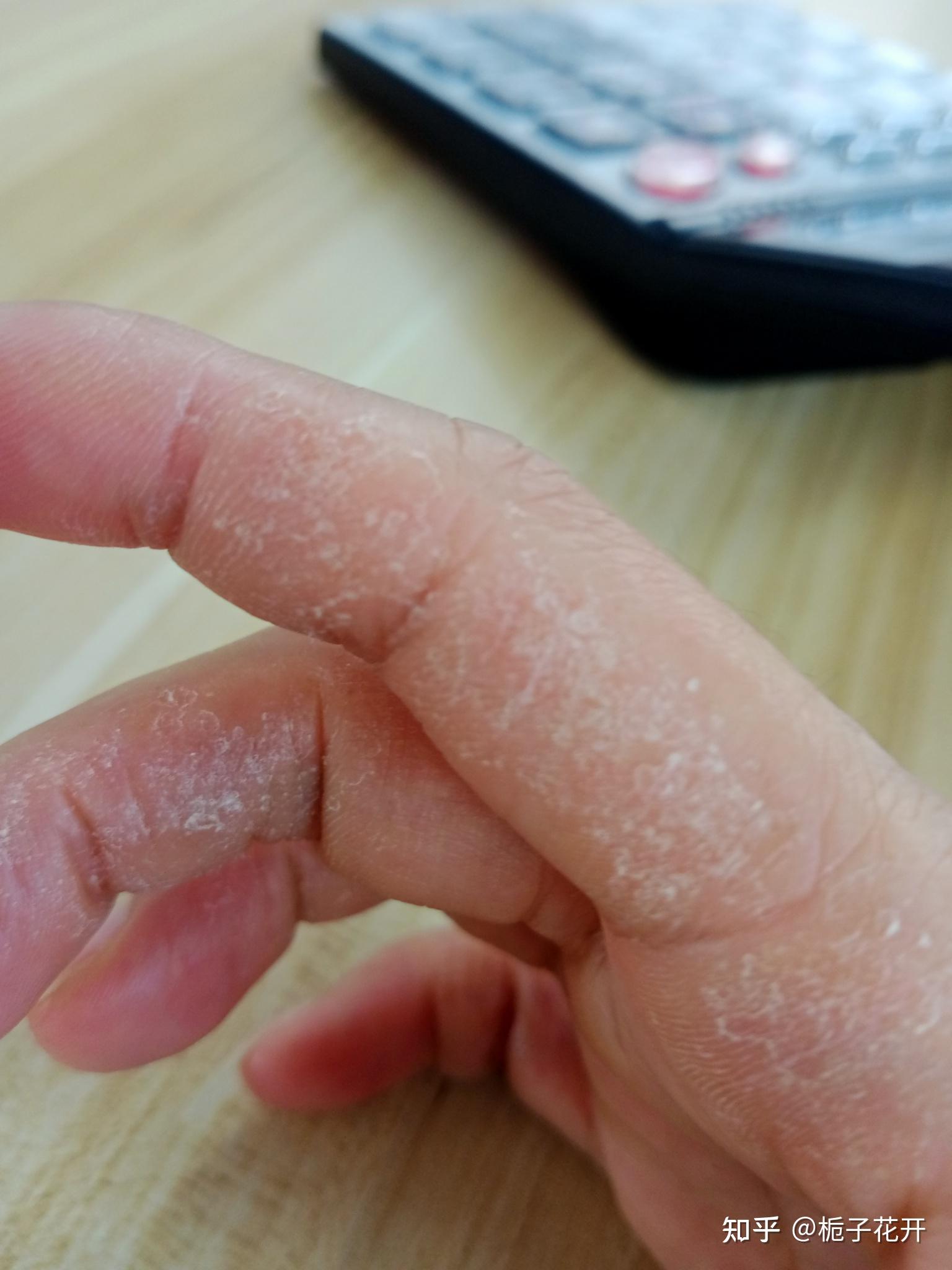 手指上长了厚厚的一层感觉很硬很痒会蜕皮一层去了又来一层有没有知道