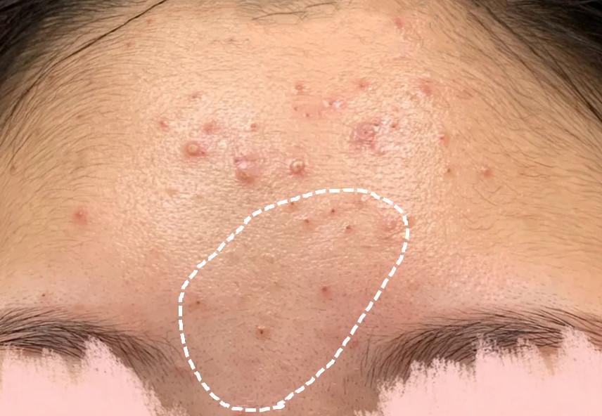 额头上的闭口粉刺如何解决? - 知乎