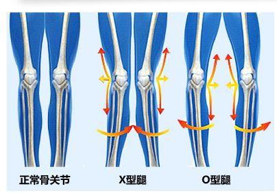 广州xo型腿在家可做的矫正计划