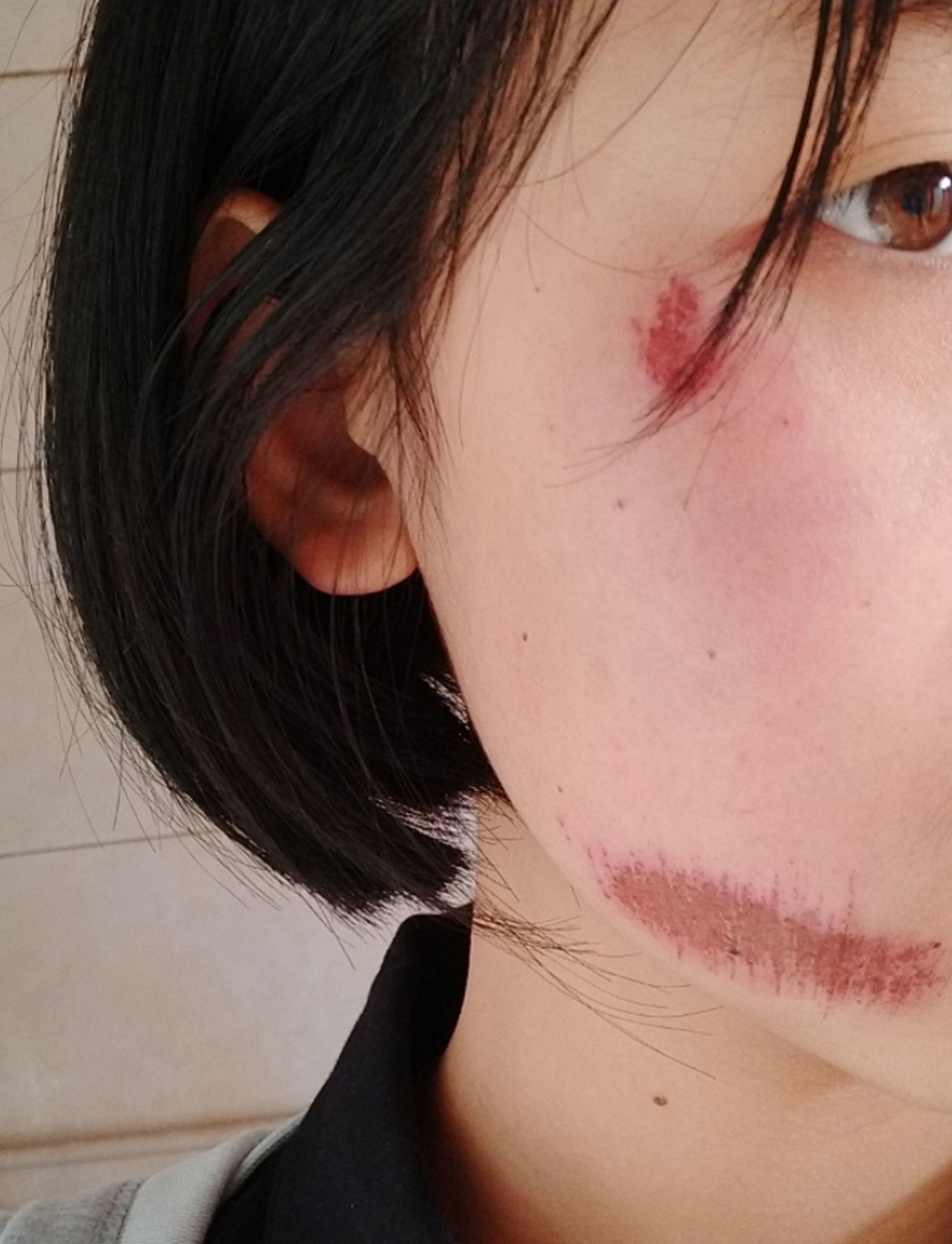 脸上缝了四针留了疤有没有去疤的方法二十六岁