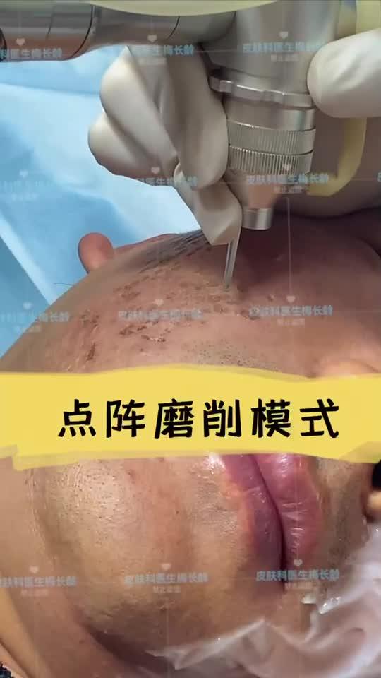 点阵激光 | 激光磨削术你了解吗?