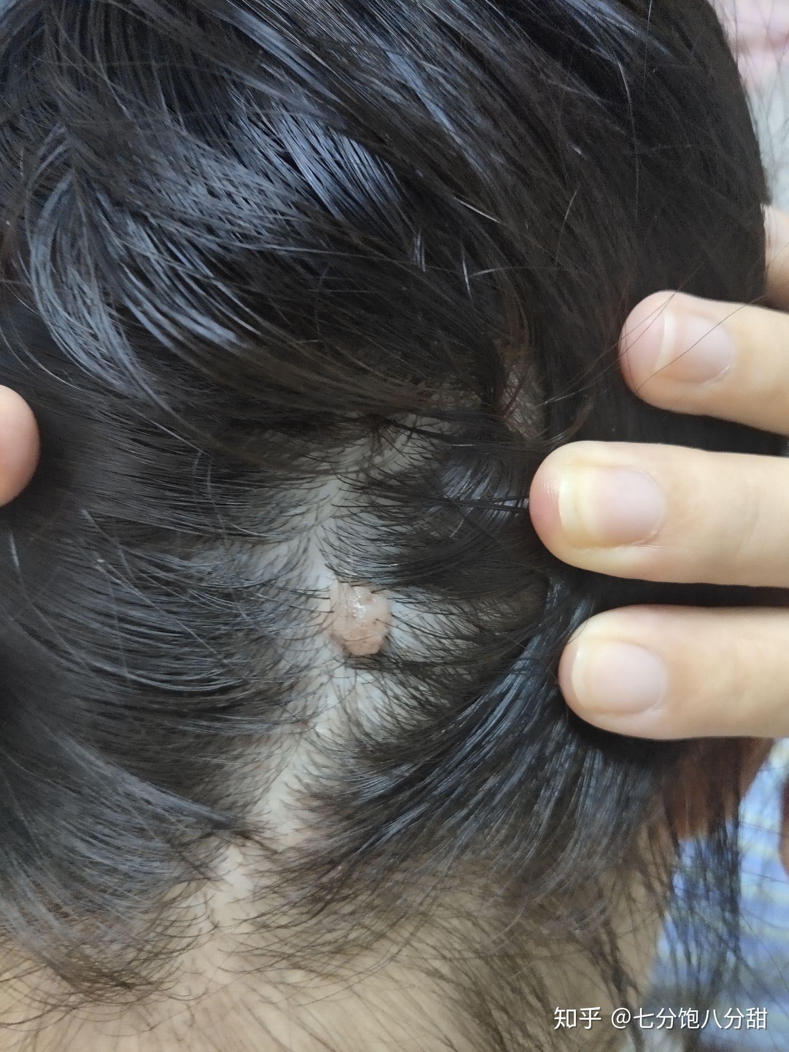 后脑勺长了一个肉疙瘩? - 知乎