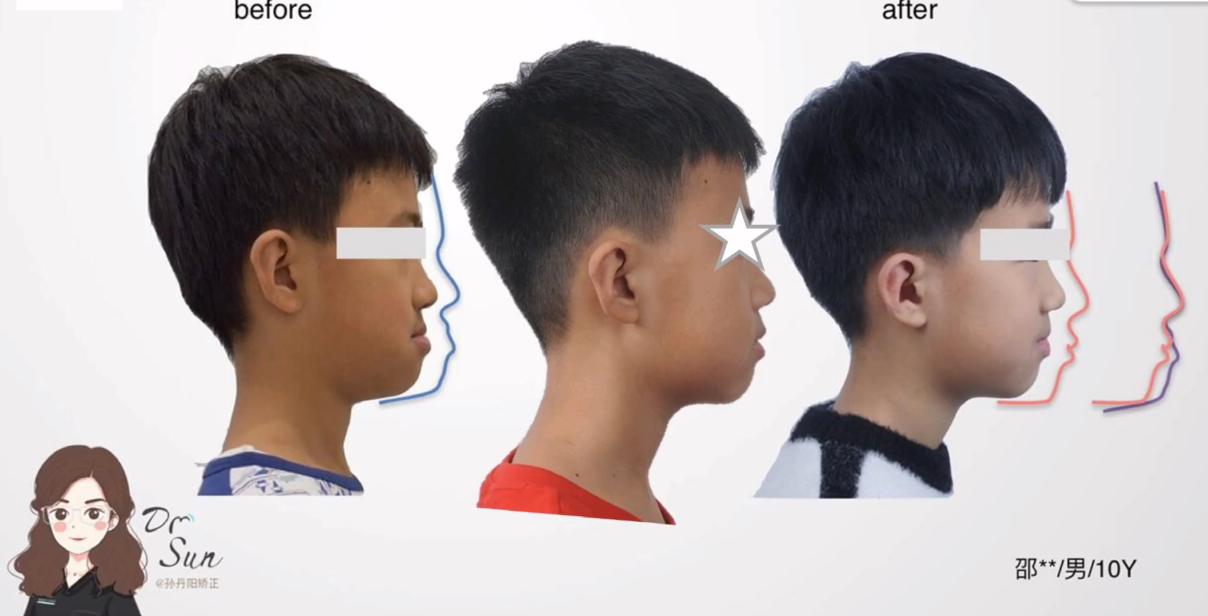 我是严重的地包天 极度的自卑 感觉生活没什么意义了 怎么办啊!