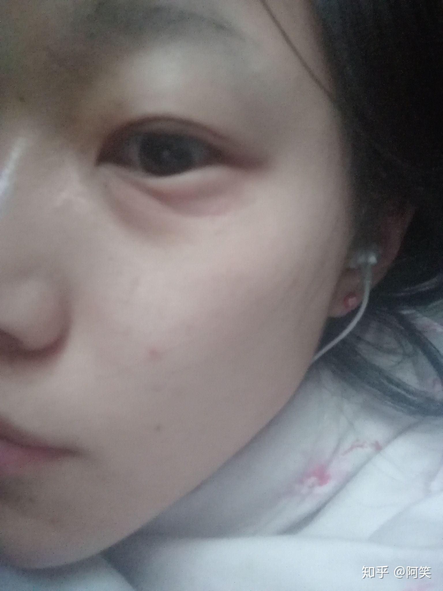 下眼袋突然肿起来是什么回事?