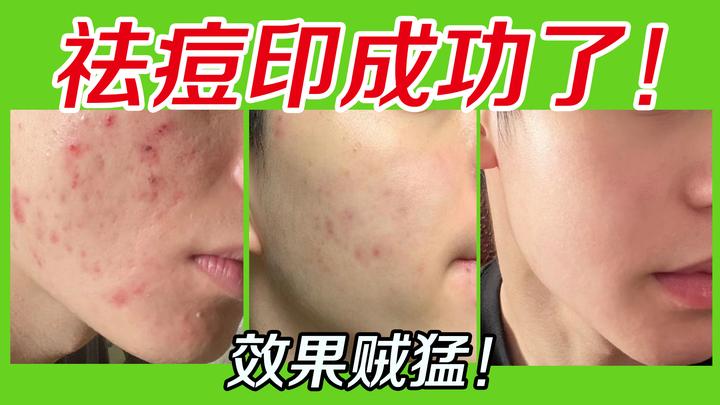 男生脸上痘印黑一块,红一块,密密麻麻一大堆,试过很多方法都没用!【皮肤科医师】教你正确有效去痘印,男生只需4步搞定满脸痘印,效果贼猛! - 知乎