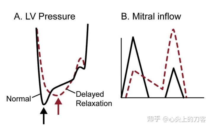 简洁的左室舒张功能减低什么意思的图像
