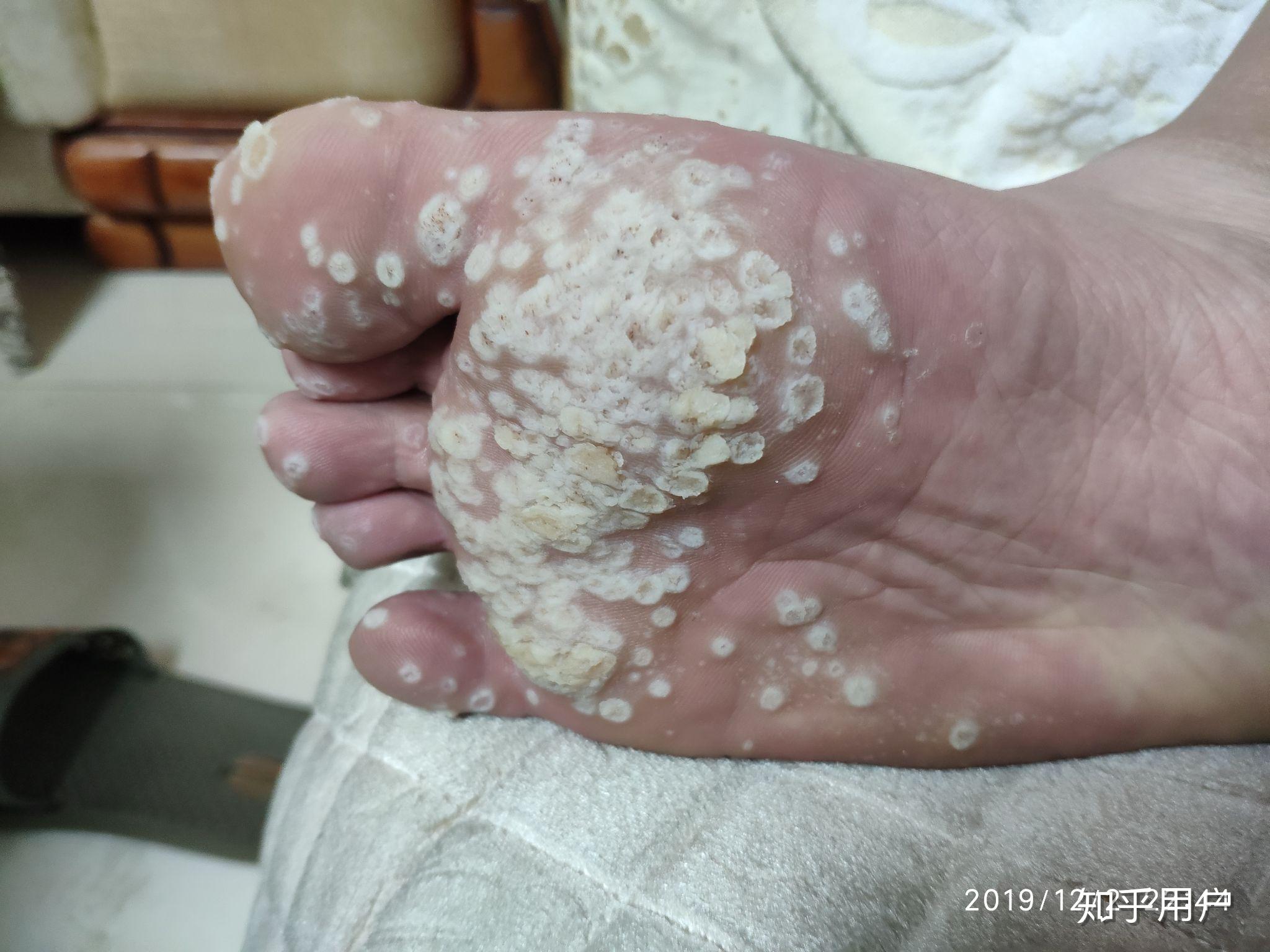 跖疣的自愈性大吗? - 知乎