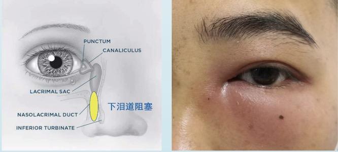 你要的泪囊炎都在这篇里 - 知乎
