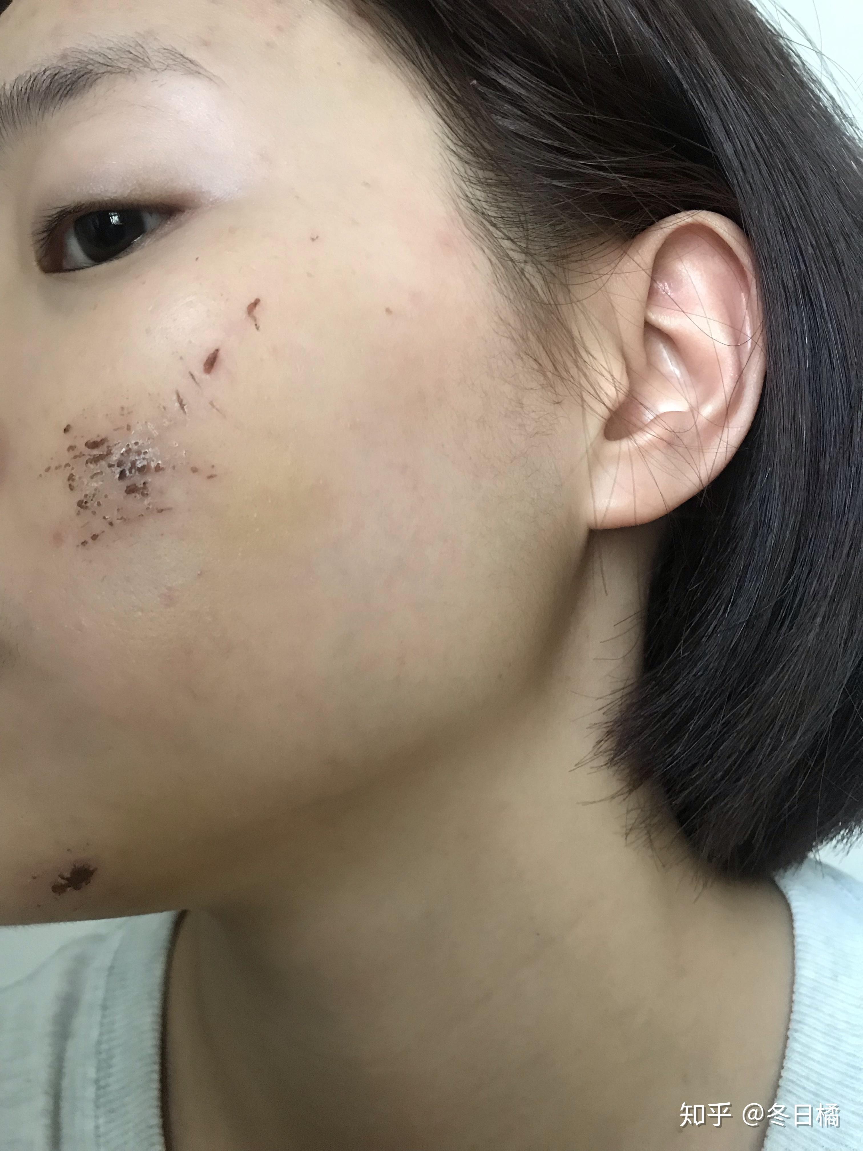 脸部擦伤结痂已经掉了但是红黑的一片怎样才能避免留疤