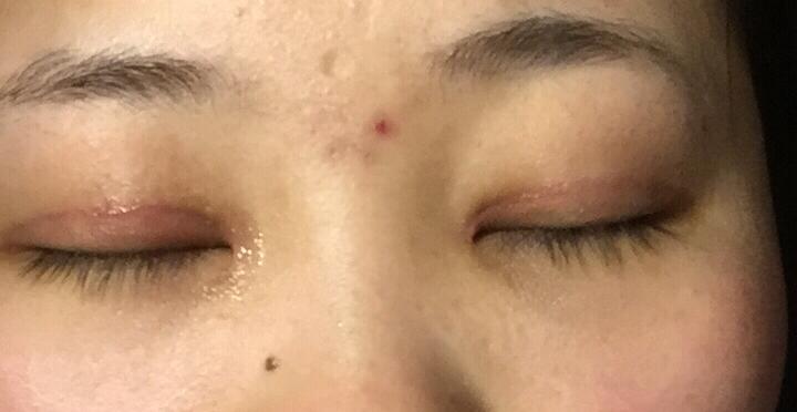 全切双眼皮加开眼角两个月了,眼角白色疤痕明显,请问各位这个情况需要