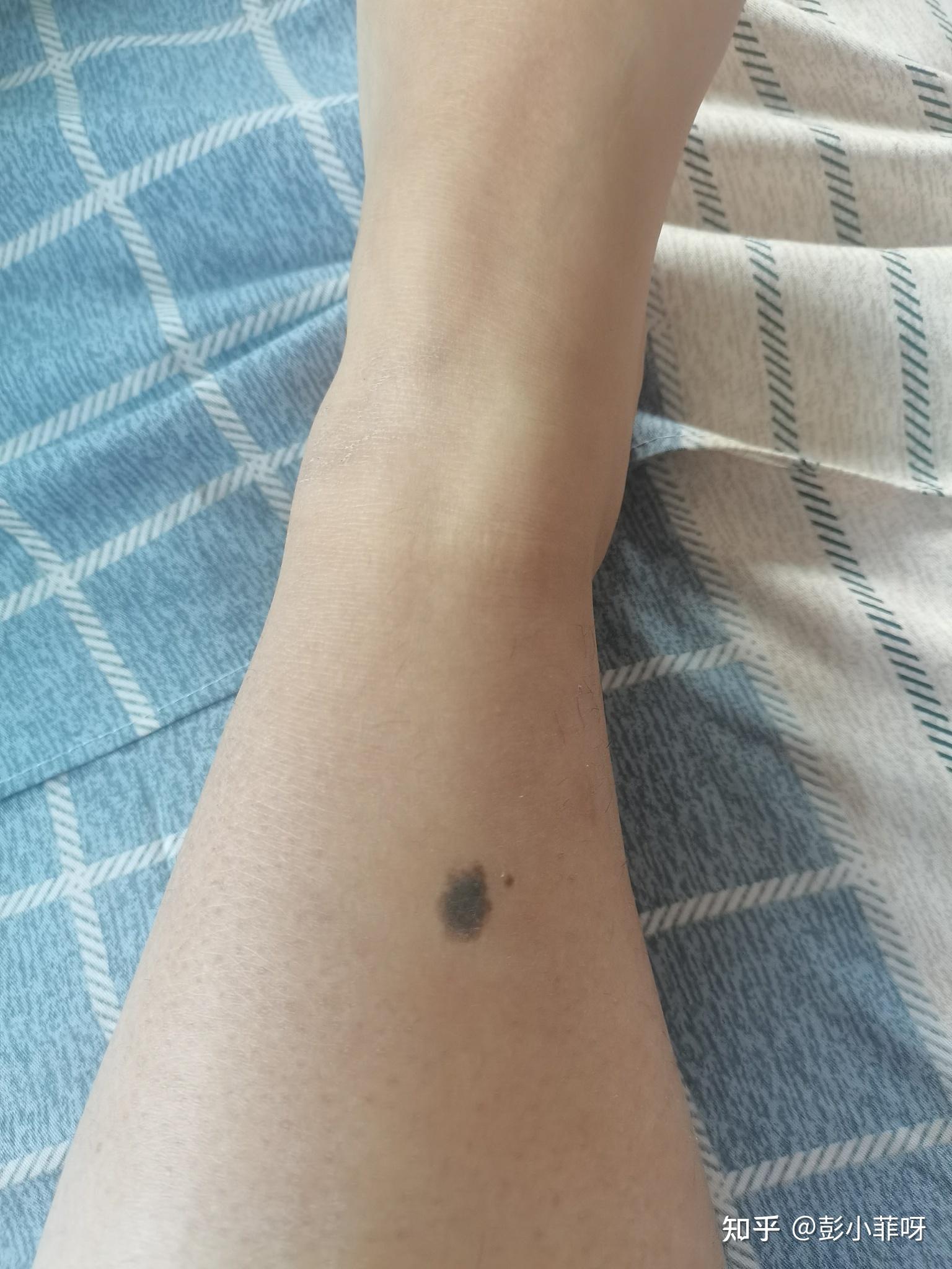 出生小腿有个大痣 一直伴随着我