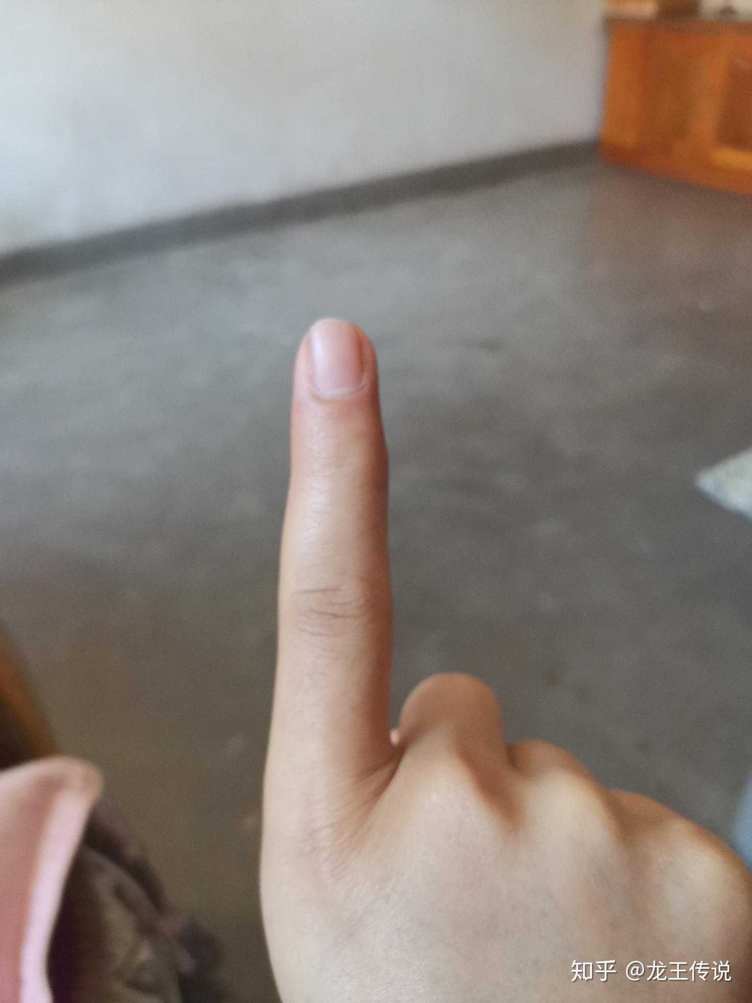 中指因为写字变形,有什么方法? - 知乎