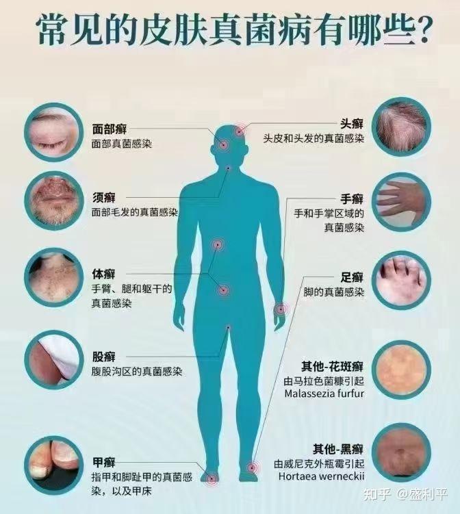 关注问题 ​ 写回答 登录/注册 皮肤病 癣 这是癣吗?