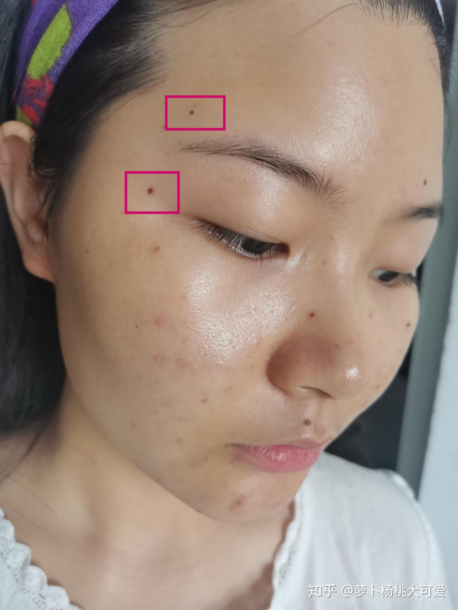 去医院做激光去痣需要多少钱