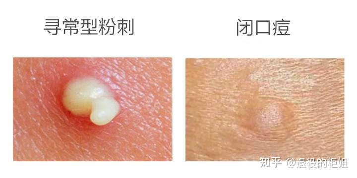 黑头与暗疮之间有什么区别？ - 知乎