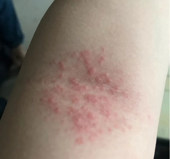 湿疹图片初期症状图片一般湿疹多久会消失