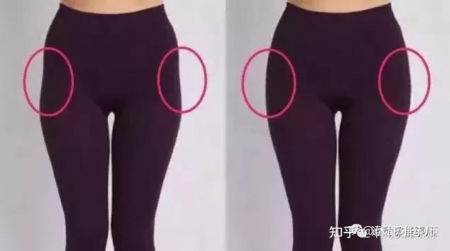 臀部两侧凹陷 女性图片