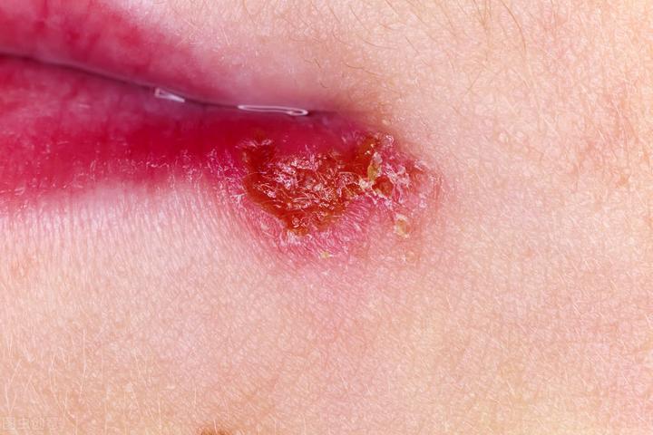 口唇疱疹传染吗?