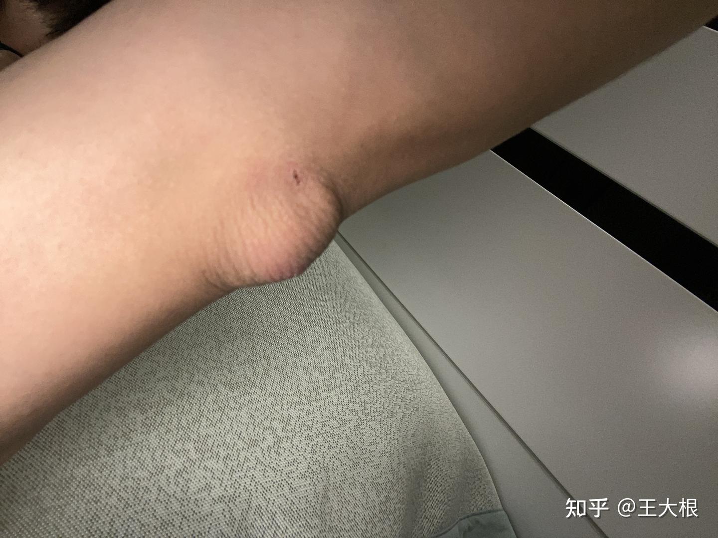 火疖子自救日记 - 知乎