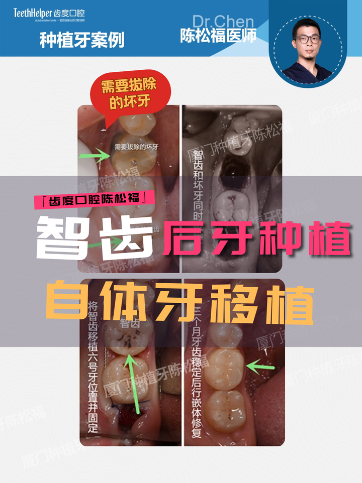 24岁根折救牙记 自体牙移植,把“自己的牙”放回原位 - 知乎