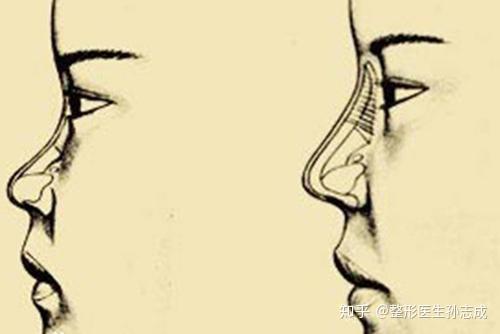 塌鼻子(低鼻与鞍鼻)怎么矫正? - 知乎