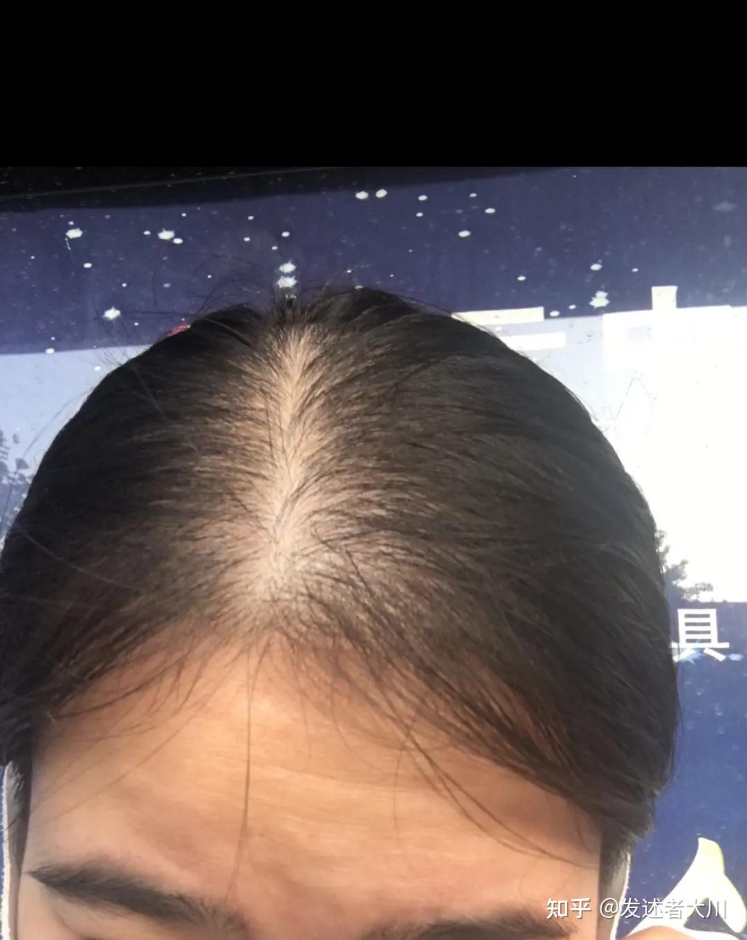 女孩子脱发怎么办 ? - 知乎