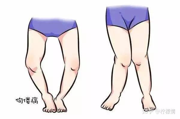 有哪些因素会导致维生素 d 缺乏性佝偻病?