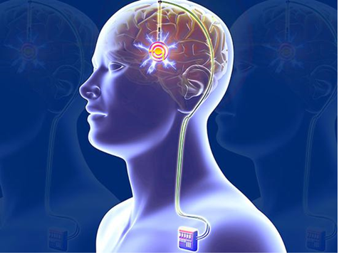 帕金森病脑起搏器dbs治疗