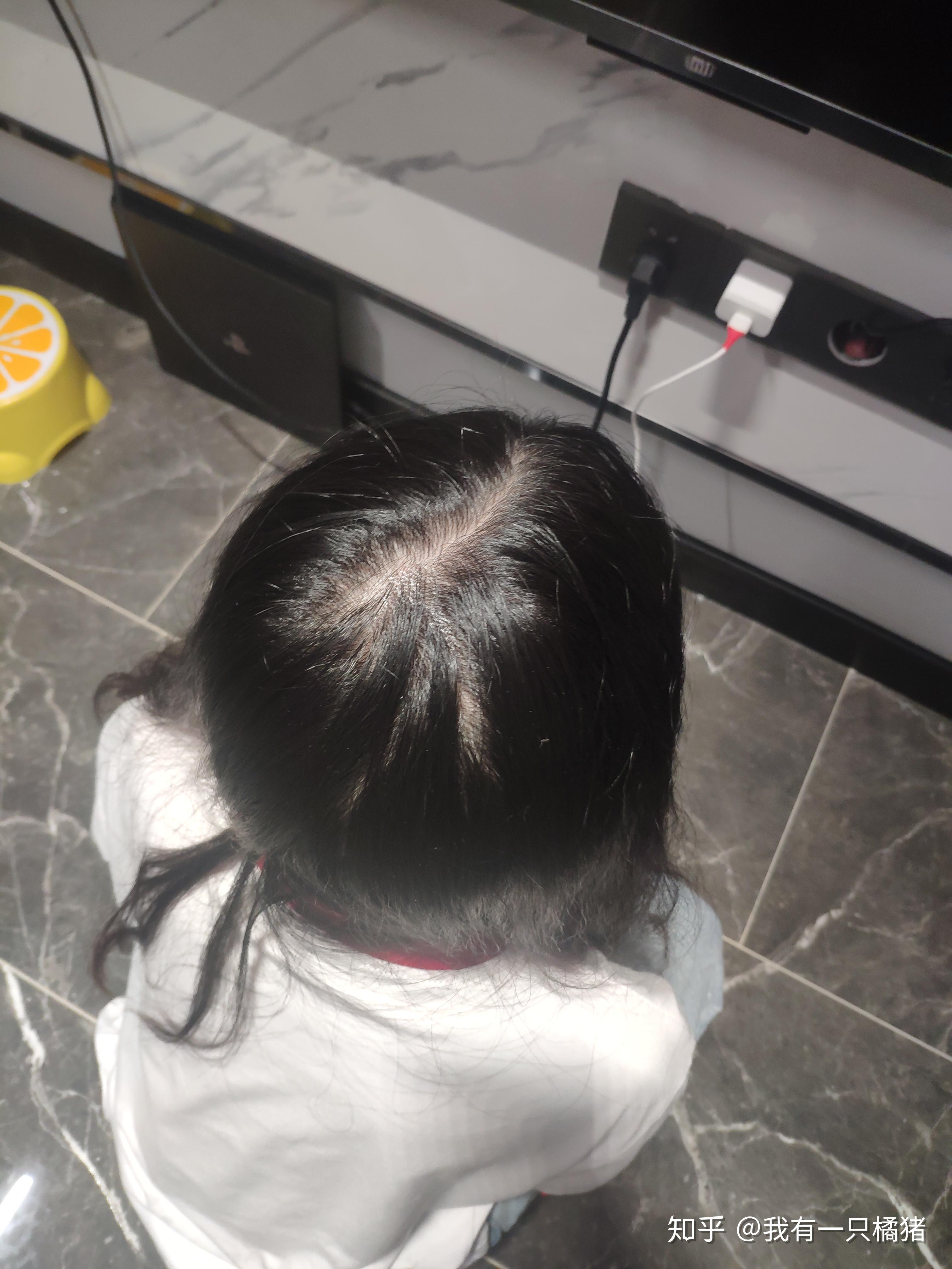 关注问题 67 写回答 登录/注册 头发 秃顶 女性脱发 请问女孩子