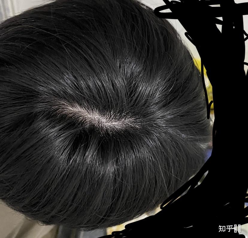 什么样子的发旋是正常的啊