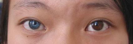 现实中人类异色瞳虹膜异色症的概率是多少