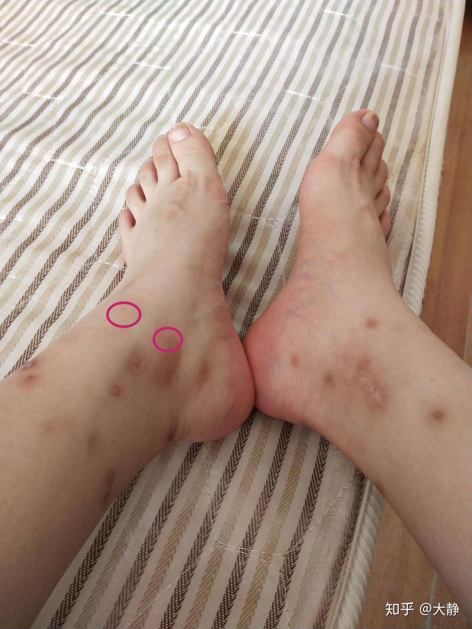 请问被跳蚤咬了有什么药膏能止痒快速消肿的啊? - 知乎