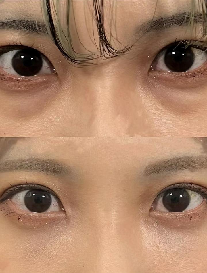 泪沟怎么填:玻尿酸、自体脂肪还是术中脂肪转移