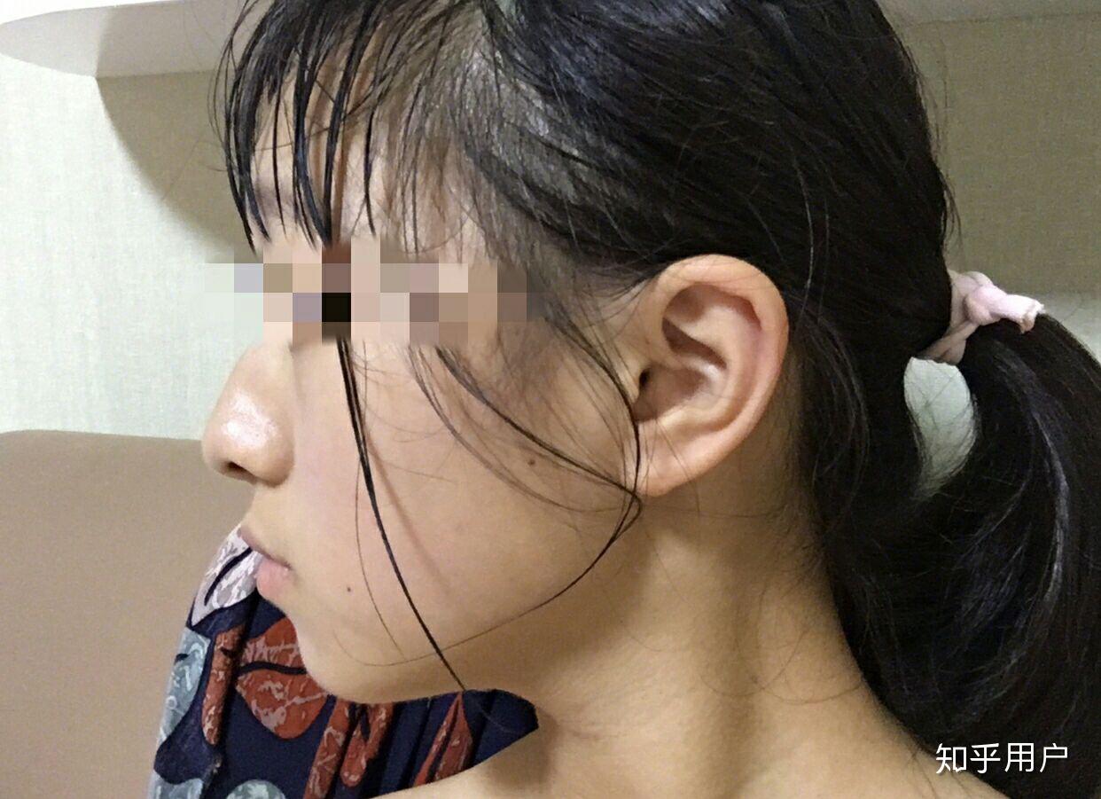 下巴后缩怎么办 如图? - 知乎