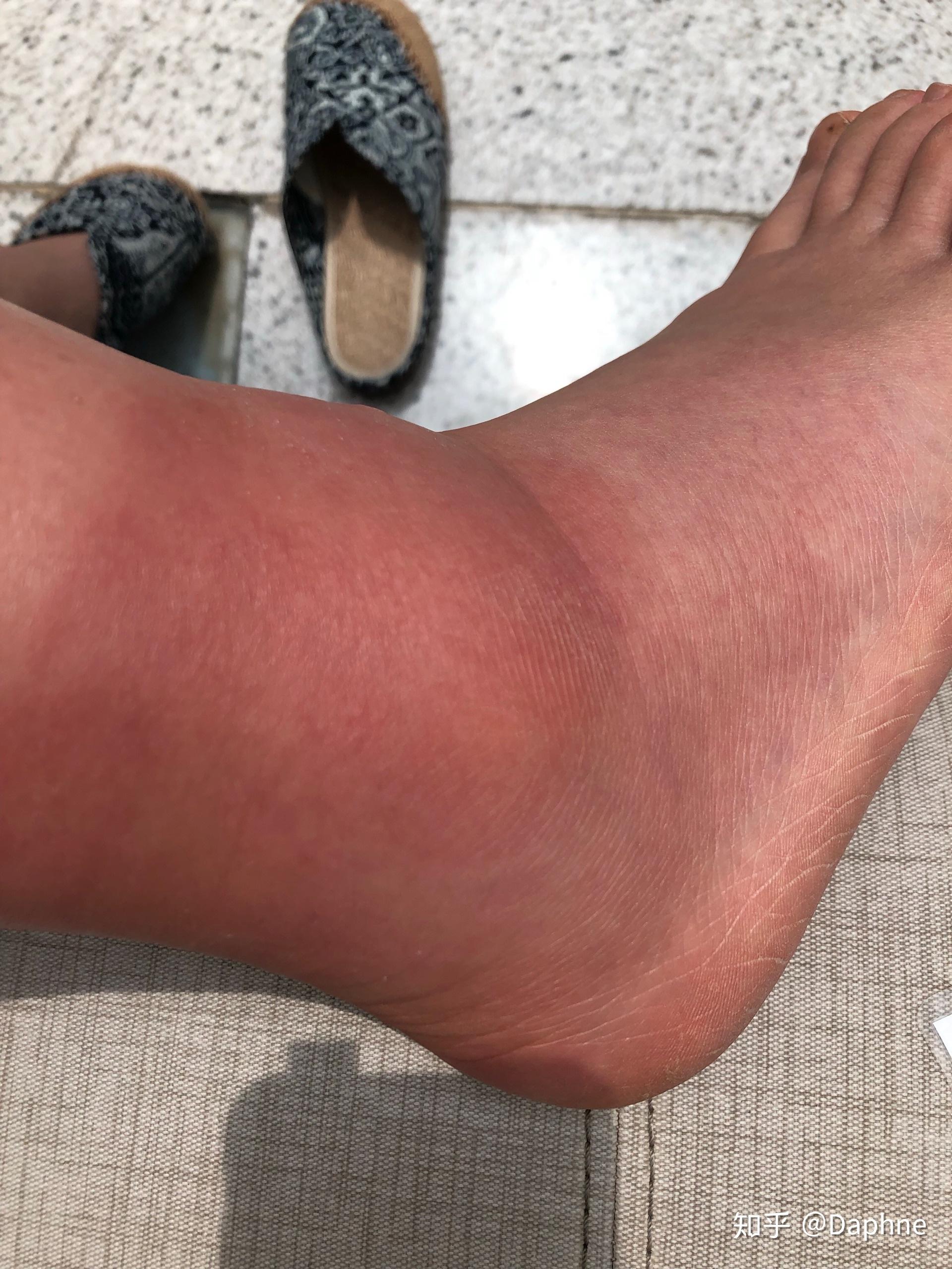 贴沈阳红膏药过敏手上红了还起了水泡怎么办才能快点好感激不尽