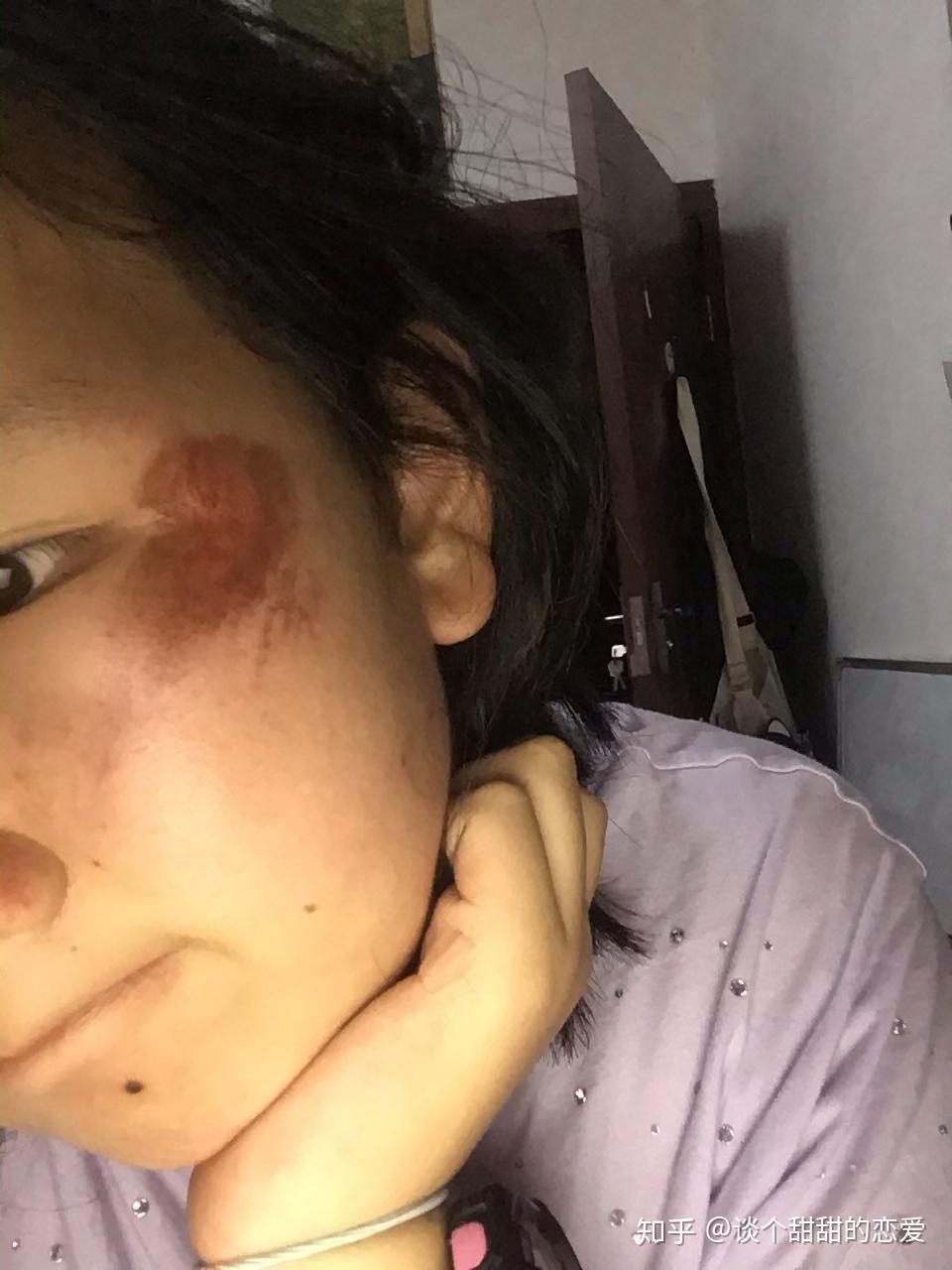 脸部擦伤如图,请问如何恢复? - 知乎